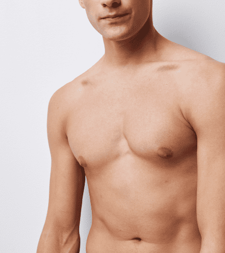 Gynecomastia gallery2