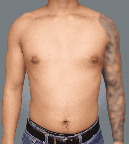 Gynecomastia gallery3