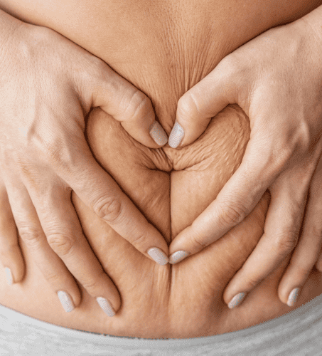 ساکشن چربی شکم