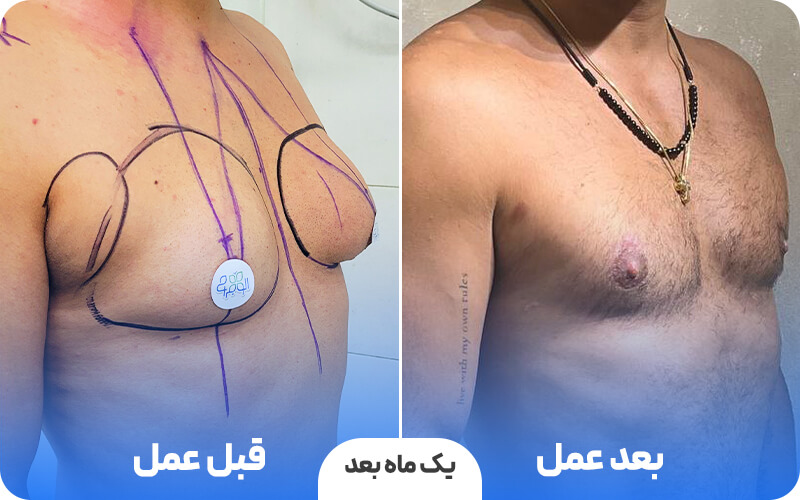 جای عمل ژنیکوماستی