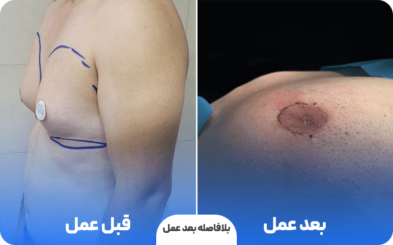 عمل ژنیکوماستی اقساطی