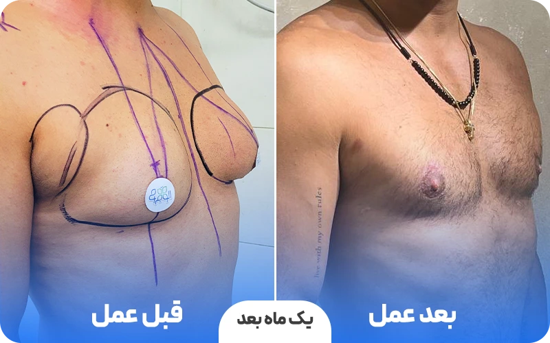 قبل و بعد عمل ژنیکوماستی در الو جراح