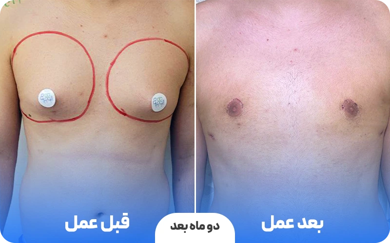 قبل و بعد عمل ژنیکوماستی در الو جراح